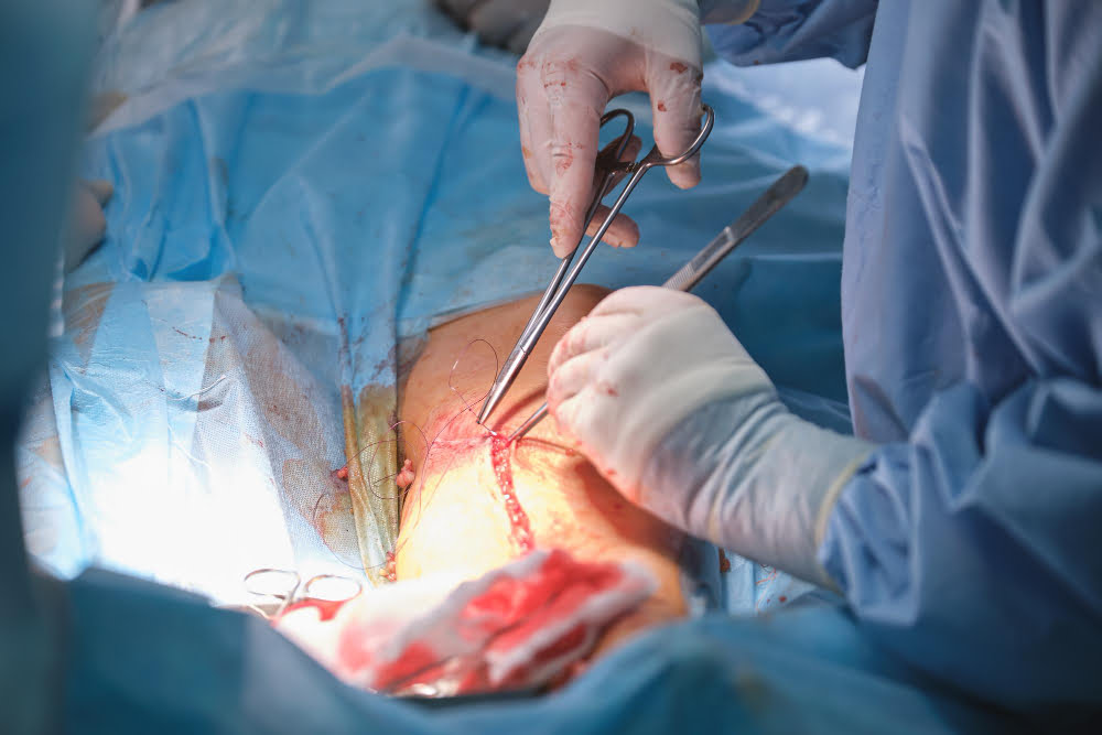 Joint Replacement Surgery